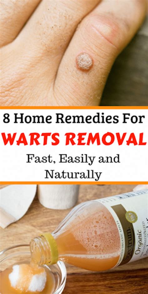 Quick Way To Remove Warts - Anna Blog