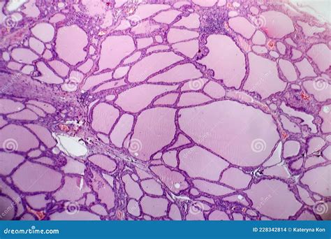 Histopathology of Endemic Goitre Stock Photo - Image of micro ...