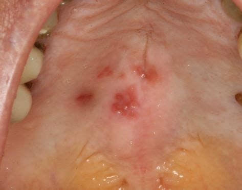 Lump on Roof of Mouth: Causes, Pictures, NHS, Hard Bumps, Small, Large ...