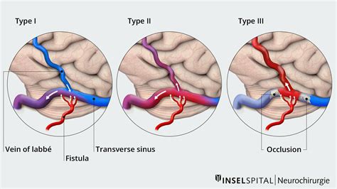 Pdf Dural Arteriovenous Fistula And Cerebral Venous Thrombosis | My XXX Hot Girl