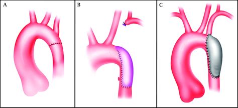 The adult with repaired coarctation of the aorta | Heart