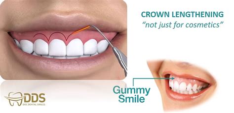 CROWN LENTHENING - DocDentalSmile