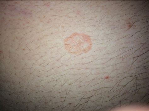 rashes on stomach and arms - pictures, photos