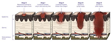Stages of melanoma - MSCAN