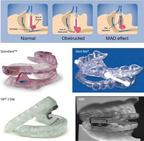 Orthodontic CE Article - A comparative review of mandibular advancement ...