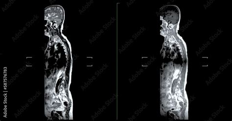 MRI Screening whole spine for diagnosis compress spinal cord ...