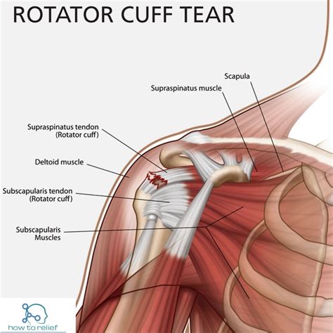 Rotator Cuff Tear! Symptoms, Causes, Diagnosis, Treatment & Exercises » How To Relief