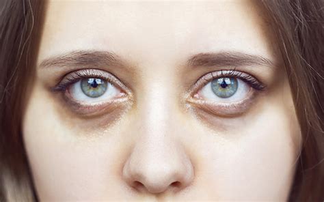 Dark Circles Under Eyes: Causes, Treatments & Preventive Tips – Vedix