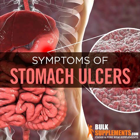 Stomach Ulcers: Causes, Symptoms, and Treatment