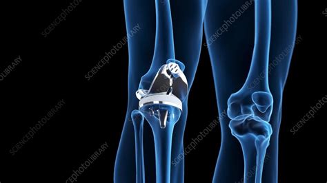 Animation of a knee replacement - Stock Video Clip - K012/0241 ...