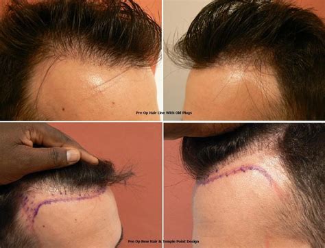 Dr.Bisanga, BHR Clinic, 2769 FUE, Hair line and Scar Repair, Plug ...