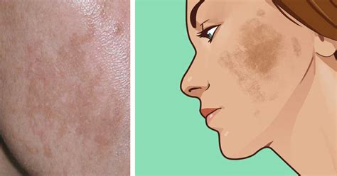 6 easy ways to help treat dark skin patches at home | Skin ...