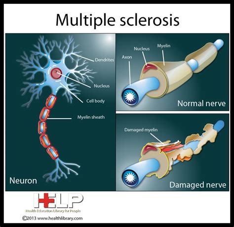 Multiple Sclerosis | Nervous System | Pinterest