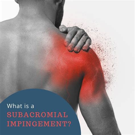 Shoulder pain? It could be subacromial impingement. - Our Chiro