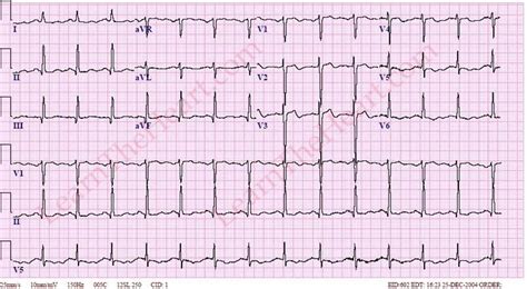 Wellen's Sign - ECG Example 5 | LearntheHeart.com