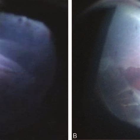 Ultrasound B-mode echography photograph of the patient's right eye (A)... | Download Scientific ...