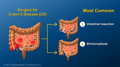 Slide Show - Small Bowel and Large Bowel Surgery for IBD