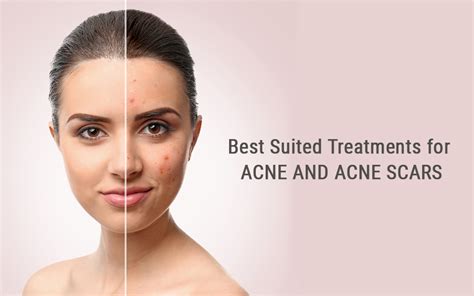 Acne Scar Treatment in Hyderabad | Laser Treatment For Acne Scar