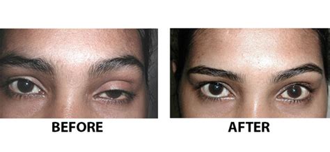 Hooded Eye Botox Eyebrow Lift: Everything You Need To Know