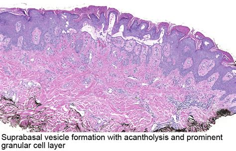 Pathology Outlines - Transient acantholytic dermatosis