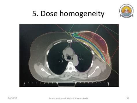 Hypofractionated Radiation Therapy in Breast Cancer