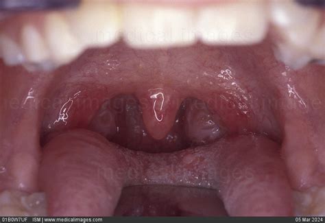 STOCK IMAGE, close-up of normal tonsils, 90495, 01B0W7UF , ISM - Search ...