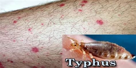 About Typhus - Assignment Point