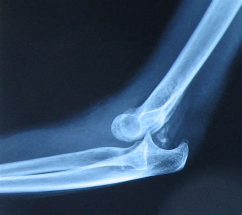 Xrays of Elbow Injuries | Bone and Spine