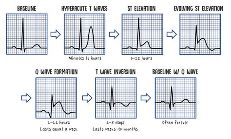 Stemi Ecg Examples