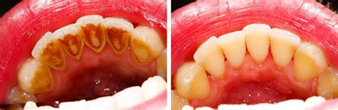 Teeth Cleaning Before And After