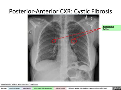 Cystic Fibrosis: Posterior-Anterior Chest X-Ray | Calgary Guide