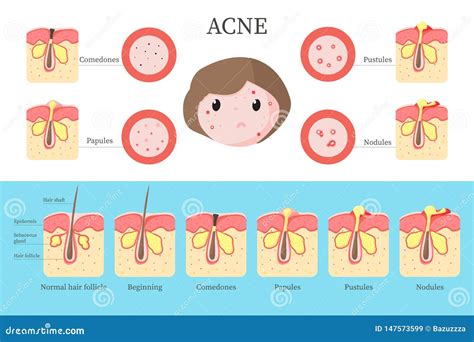 Acne Types. Skin Infection Problem, Pimples Grade And Type Cyst, Whitehead, Blackheads, Nodule ...