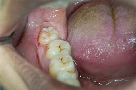 Signs Of Impacted Wisdom Tooth