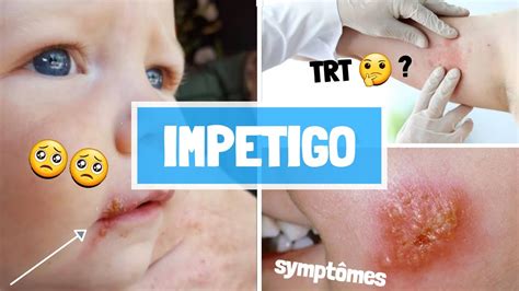 IMPETIGO ( CAUSES , SYPMTOMES , COMPLICATIONS , TRAITEMENT ) - YouTube