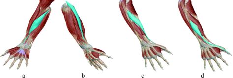 Radial Deviation of the hand. (a) Flexor carpi radialis longus, (b)... | Download Scientific Diagram