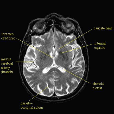 Technology and Techniques in Radiology: Foramen of monro in MRI