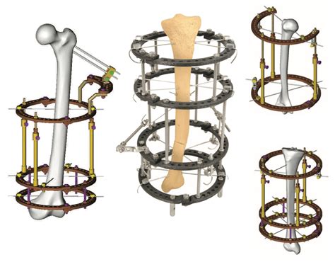 Ultimate Guide of External Fixator - Orthopromed Inc. Medical