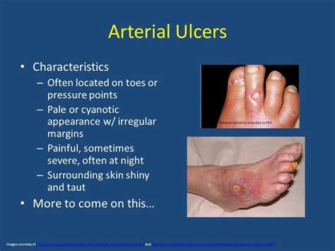 Arterial ulcer_explained (note:pale or cyanotic appearance) | Medical laboratory science student ...