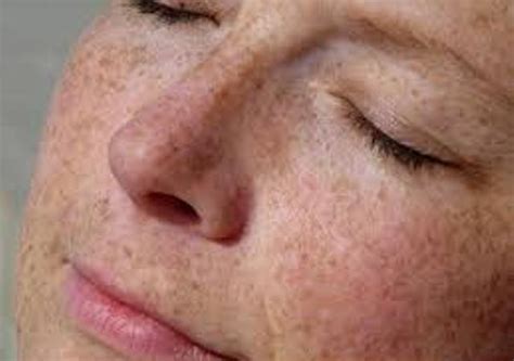 Skin Care Update: What Is Hyperpigmentation