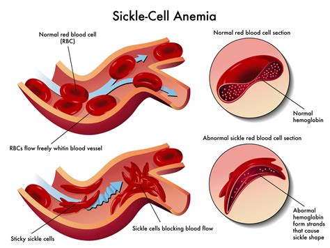 Haemoglobin and Anemia? - anémie