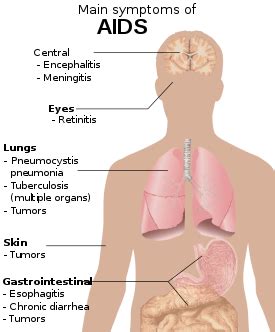 HIV/AIDS - Wikipedia, the free encyclopedia