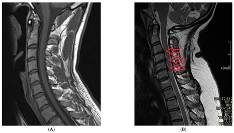 Cervical Spine Mri Comparison