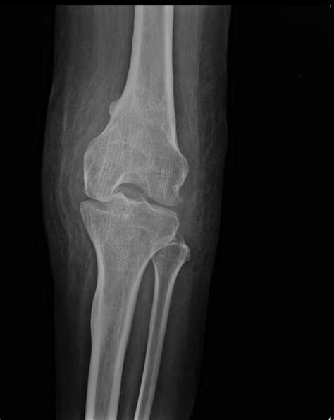 Patella fracture | Image | Radiopaedia.org