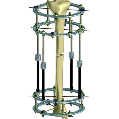 Leg Lengthening Surgery | Is The Height Gain Worth The Risk And Pain?