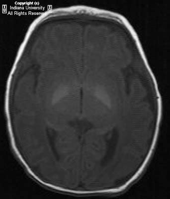 Neuroradiology On the Net: Kernicterus