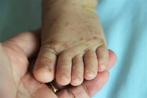 Scabies In Babies: Causes, Symptoms And Treatment - Being The Parent