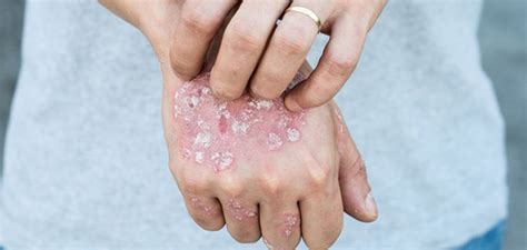 Psoriasis and Alcohol - Dr. Health Clinic - Homepage