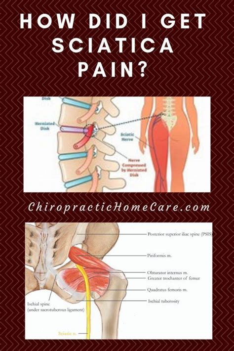 Get rid of hip pain sciatica – Artofit