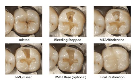 PDF] Success Of Direct Pulp Capping And Partial Pulpotomy, 54% OFF