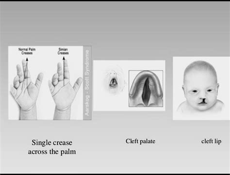 Aarskog-Scott Syndrome Archives - PT Master Guide